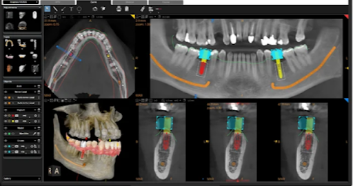 Three-dimensional CBCT scan of teeth and jawbone