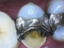 Intraoral camera image of teeth displayed for the patient