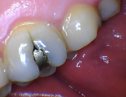 Detailed intraoral camera view of teeth and gums