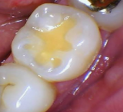 Intraoral photography documenting existing dental work