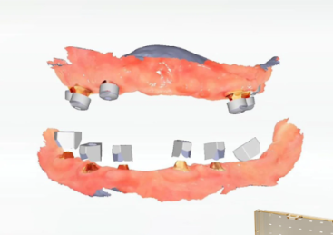 3D digital model created from an intraoral scan